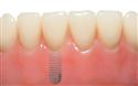 Zubni implantati 