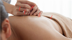 ORDINACIJA OPĆE MEDICINE, HOMEOPATIJE I AKUPUNKTURE DR. TATJANA KUNŠTEK-KUČANDA AKUPUNKTURA