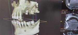 CENTRODENT - stomatološka ordinacija - Rijeka CBCT 3D SNIMANJE ZUBA
