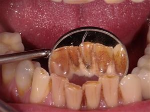 CENTRODENT - stomatološka ordinacija - Rijeka ČIŠĆENJE ZUBNOG KAMENCA