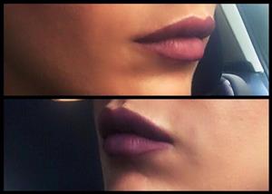 ORDINACIJA DENTALNE MEDICINE NENAD ŠARIĆ dr.med.dent. HIJALURONSKI FILERI