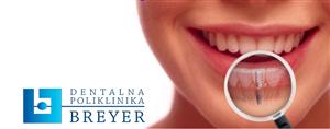 STOMATOLOŠKA POLIKLINIKA BREYER IMPLANTATI-FIXNI ZUBI