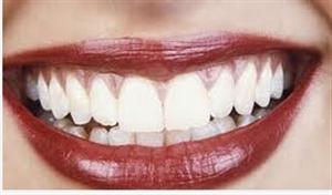 DentalTime d.o.o. za zdravstvenu djelatnost dentalne medicine IZBJELJIVANJE ZUBI