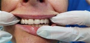 Bell Dent centar dentalne medicine PARODONTOLOGIJA