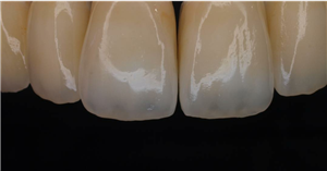 CENTRODENT - stomatološka ordinacija - Rijeka ZUBNE KRUNICE