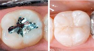 CENTRODENT - stomatološka ordinacija - Rijeka ZUBNE PLOMBE