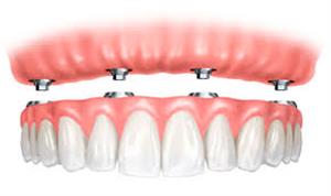 CENTRODENT - stomatološka ordinacija - Rijeka ZUBNE PROTEZE NA IMPLANTATIMA