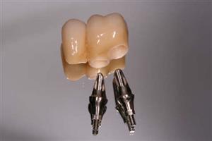 PRIMUS DENTAL d.o.o. ZUBNI IMPLANTATI